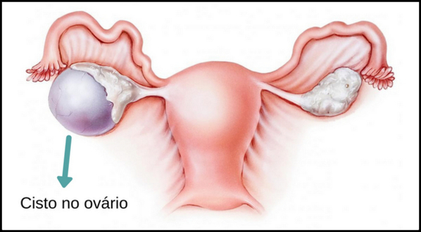 Quais os sintomas de cisto no ovário Médico Responde